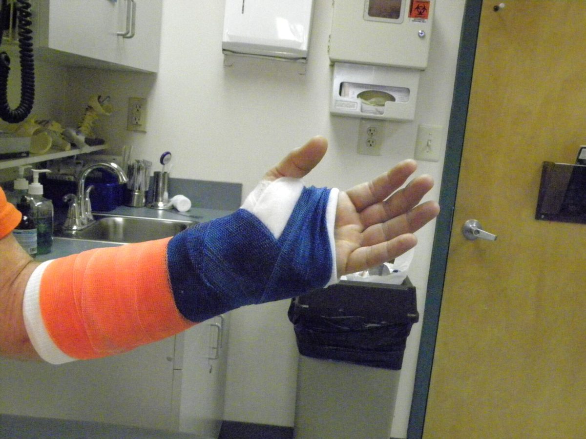 Cast set with orange and blue tape